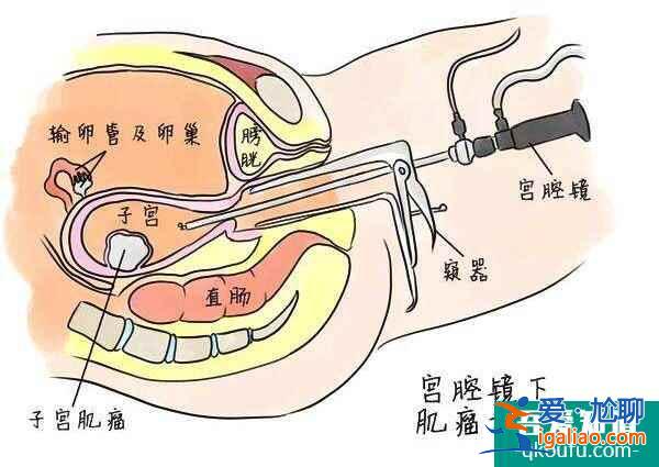 試管嬰兒助多發性子宮肌瘤女性贏好孕人生？